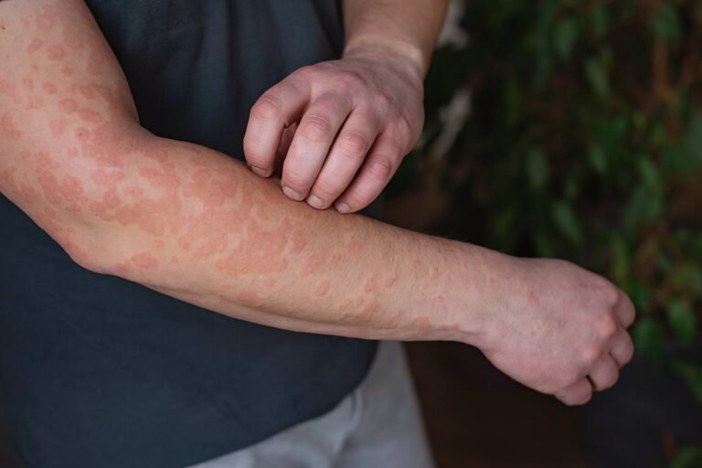 Comida e até remédio: alergia a corante alimentício muda vida de jovem