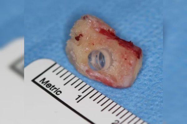 Implante de dente no olho de pacientes restaura a visão de cegos