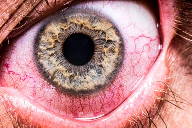 Entenda como o metanol destrói o nervo óptico e pode causar cegueira