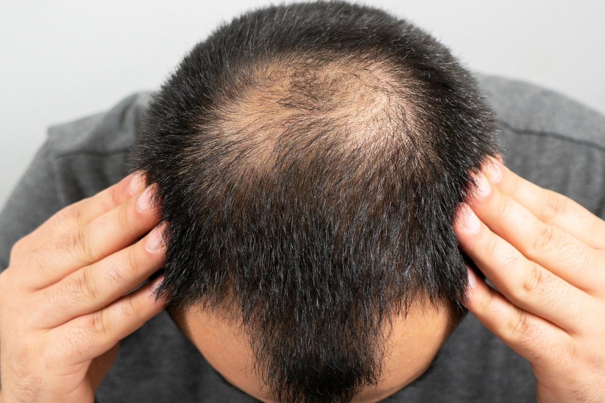 Remédio contra calvície é ligado a risco de depressão e suicídio