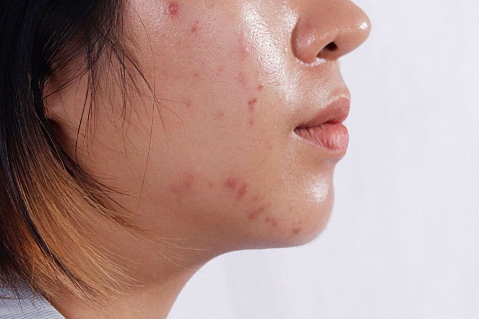 Só uma cutucada! Por que sentimos tanta vontade de espremer espinhas?