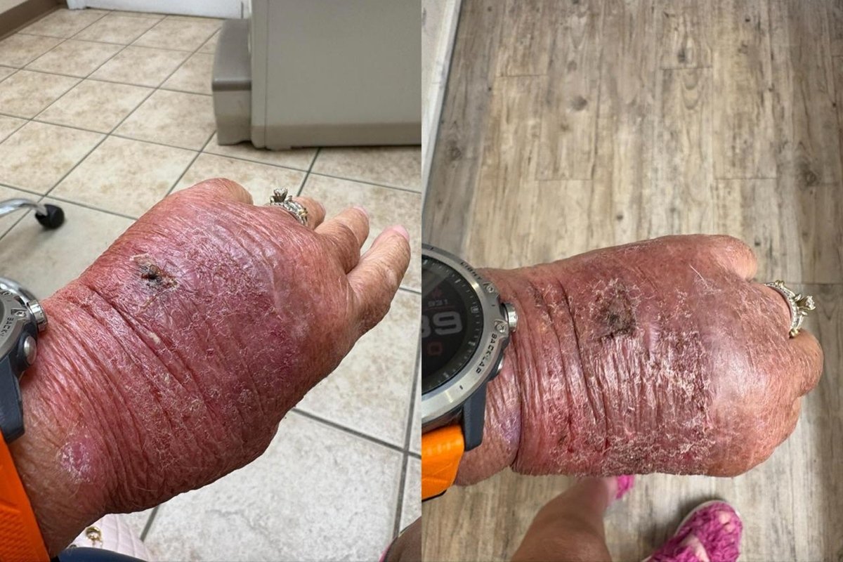 Corte com papelão infecciona e leva mulher de 63 anos ao hospital