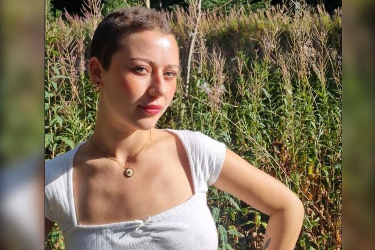 Jovem perde todo o cabelo após crise de estresse no trabalho