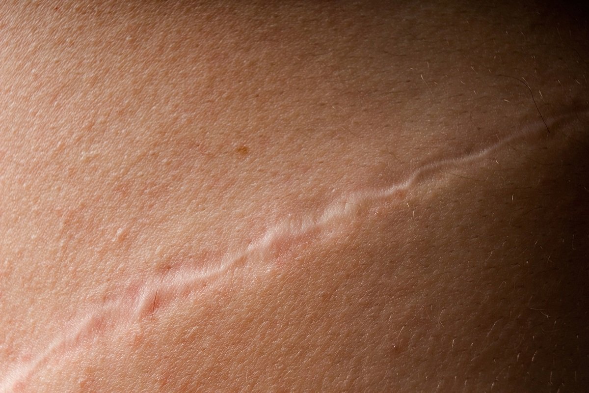 proteína ligada ao câncer ajuda a cicatrizar feridas na pele