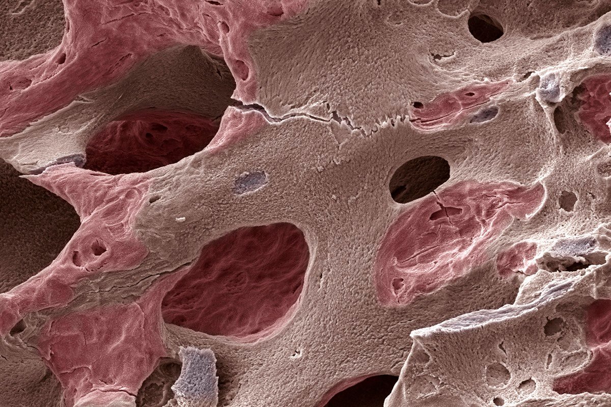 Ortopedista e fisiatra listam os principais sintomas da osteoporose