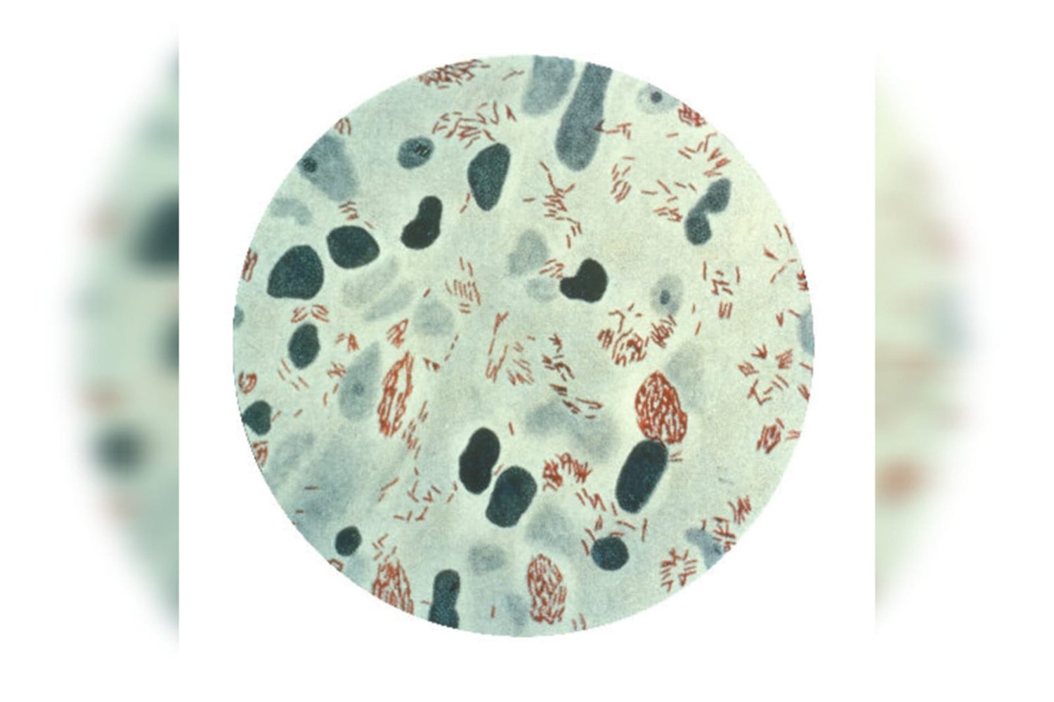 Brasil registra 22 mil casos ao ano de hanseníase. Conheça a doença