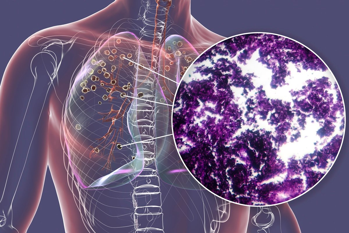 Câncer de pulmão usa “sistema de defesa” para proteger mutação maligna