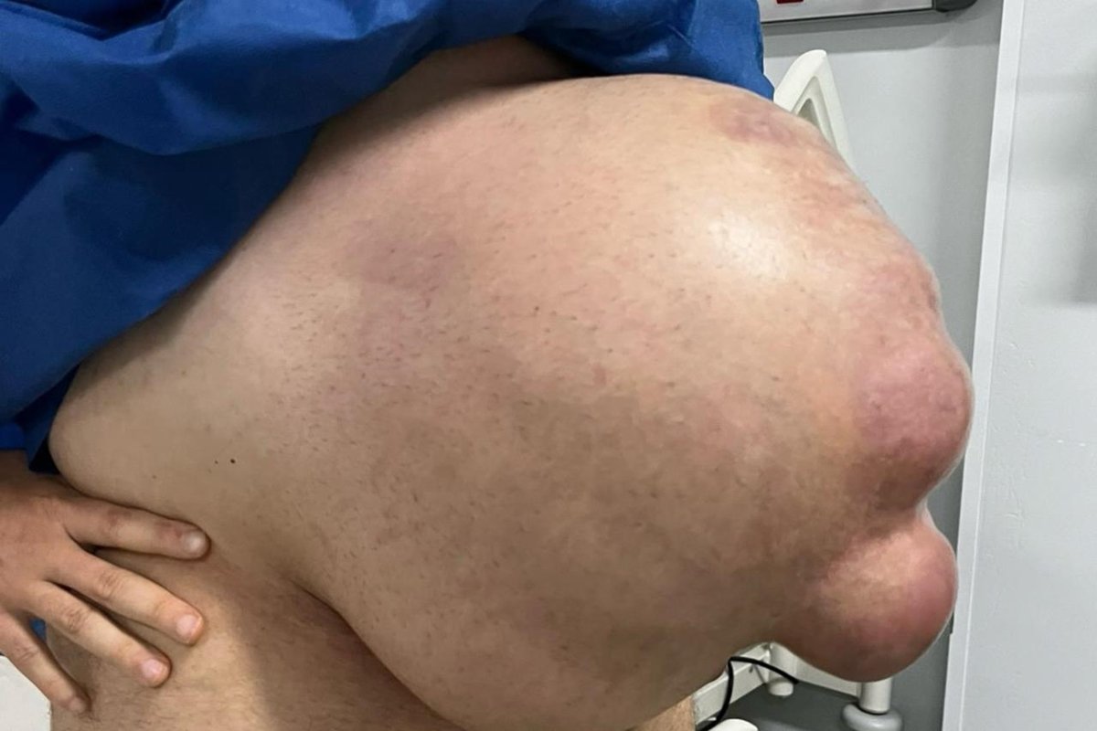 Com hérnia abdominal, homem fica com barriga enorme: "Cresceu em 1 mês"