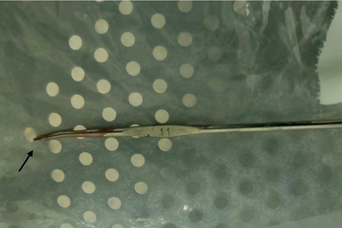 Menino senta em agulha de crochê e cirurgia vira um desafio