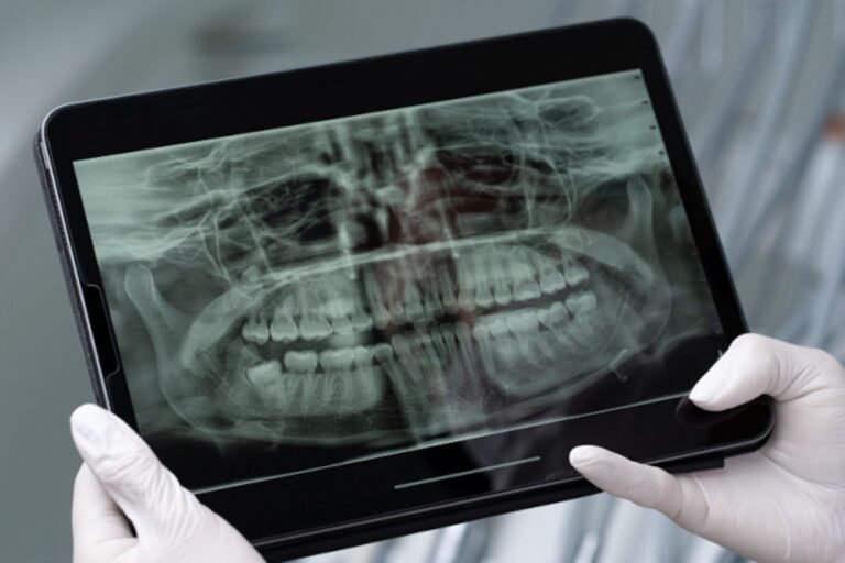 Saliva artificial à base de cana pode proteger dentes na radioterapia