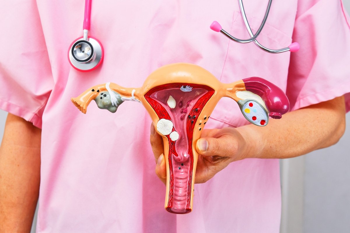 Câncer de colo de útero: sintomas e prevenção