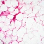 Gordura marrom pode ajudar no combate ao câncer de mama, sugere estudo