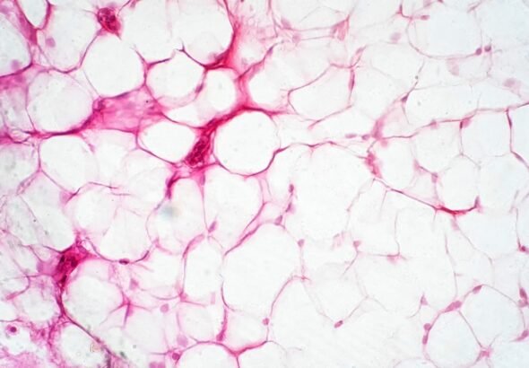 Gordura marrom pode ajudar no combate ao câncer de mama, sugere estudo