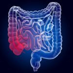 Rastreio amplia diagnóstico precoce de câncer colorretal, diz estudo