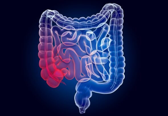 Rastreio amplia diagnóstico precoce de câncer colorretal, diz estudo