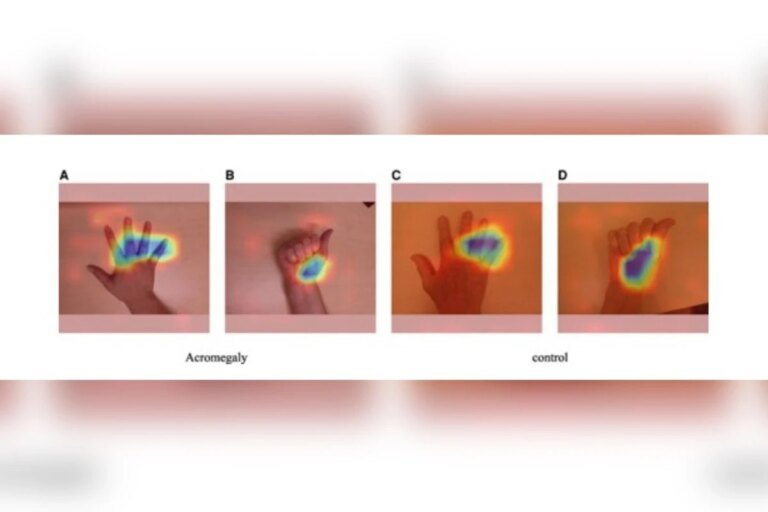 Foto da mão pode ajudar a detectar distúrbio raro com ajuda de IA