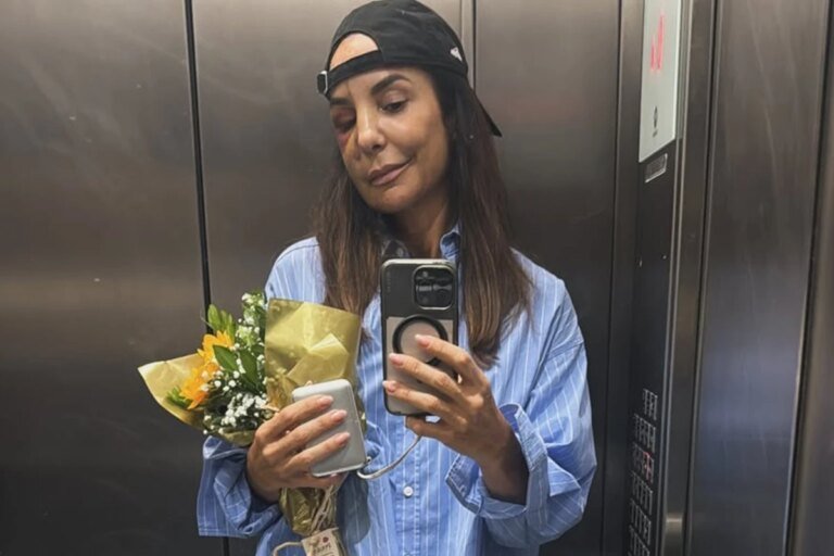 Ivete Sangalo confirma show no BBB 26 dias após cirurgia no rosto