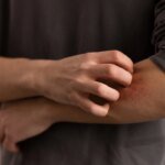 Por que algumas pessoas têm coceira após exercício ou banho quente