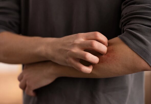 Por que algumas pessoas têm coceira após exercício ou banho quente