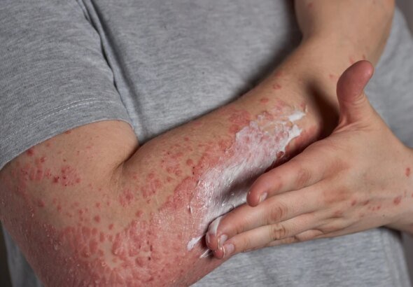 Stresse pode ativar e agravar crises de dermatite atópica, diz estudo