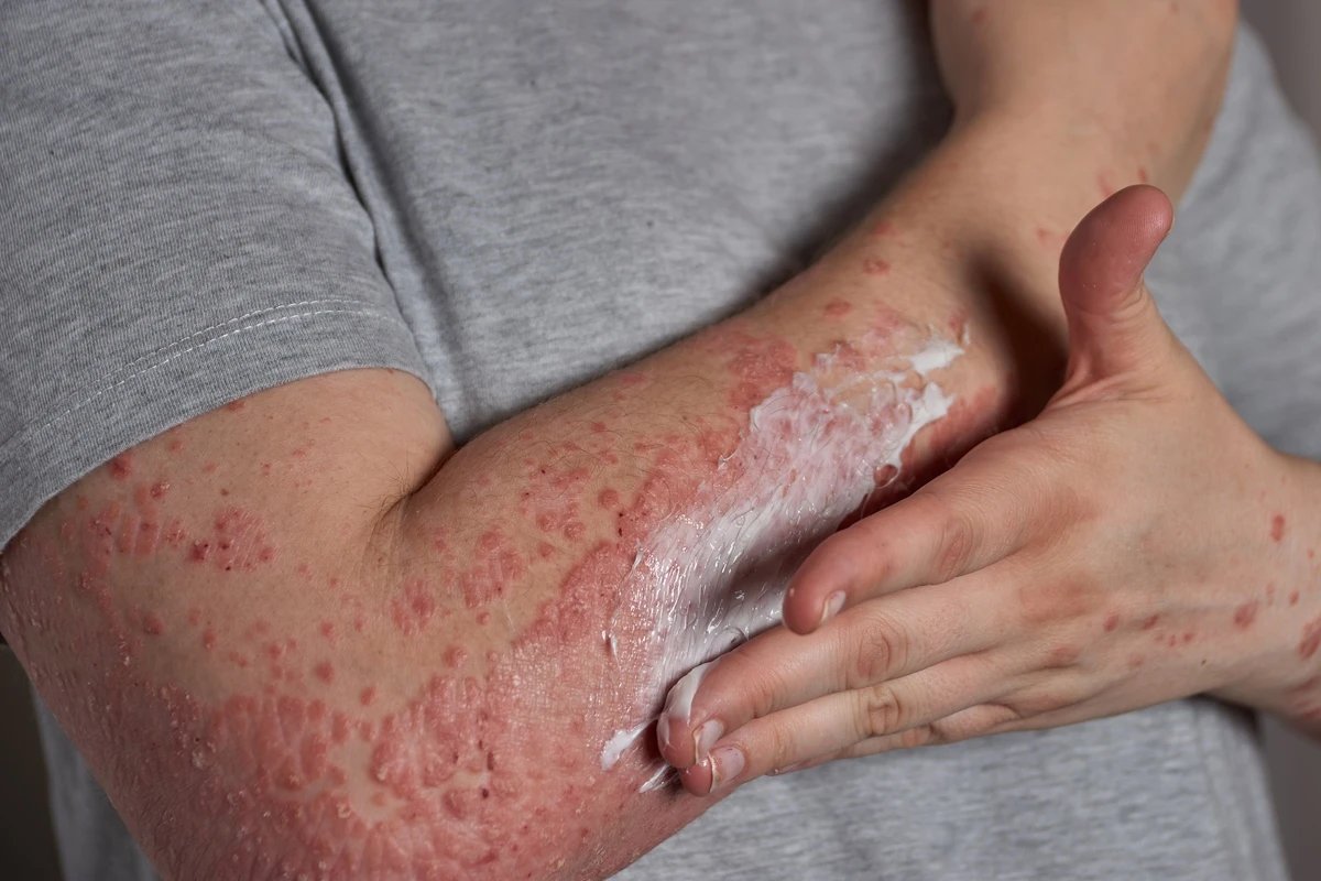 Stresse pode ativar e agravar crises de dermatite atópica, diz estudo
