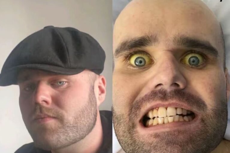 Vício em álcool deixa homem com pele e olhos amarelados