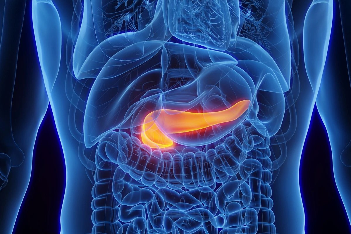 Genes ligam obesidade e diabetes a câncer de pâncreas